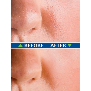 BodyVerde Pore Tight before & after example